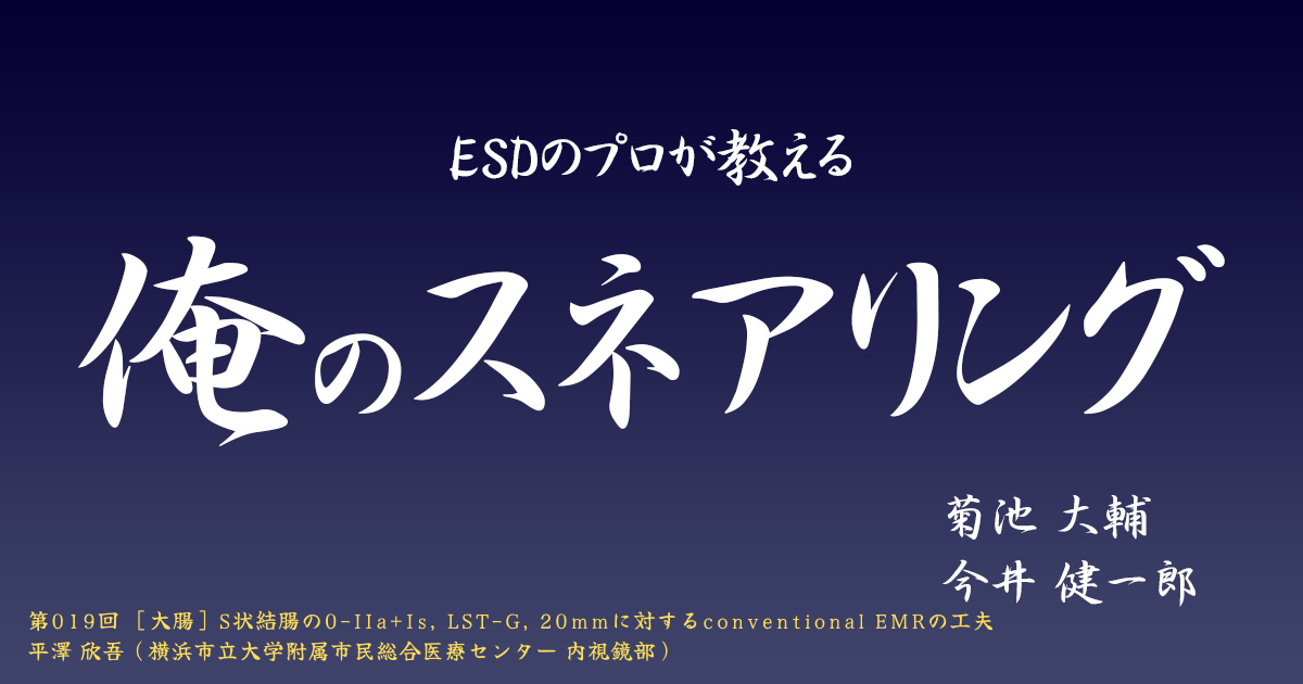 ESDのプロが教える「俺のスネアリング」　第019回［大腸］S状結腸の0-IIa+Is, LST-G, 20mmに対するconventional EMRの工夫　平澤 欣吾（横浜市立大学附属市民総合医療センター 内視鏡部）